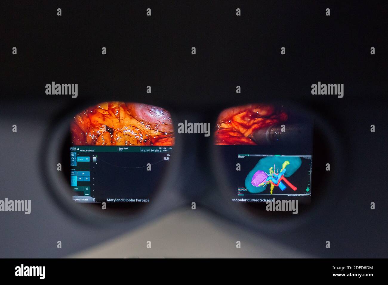 La chirurgie rénale conservatrice robotique guidée par l'image assistée par la modélisation 3D, cette modélisation 3D du rein avec sa tumeur située en violet, guide les s. Banque D'Images