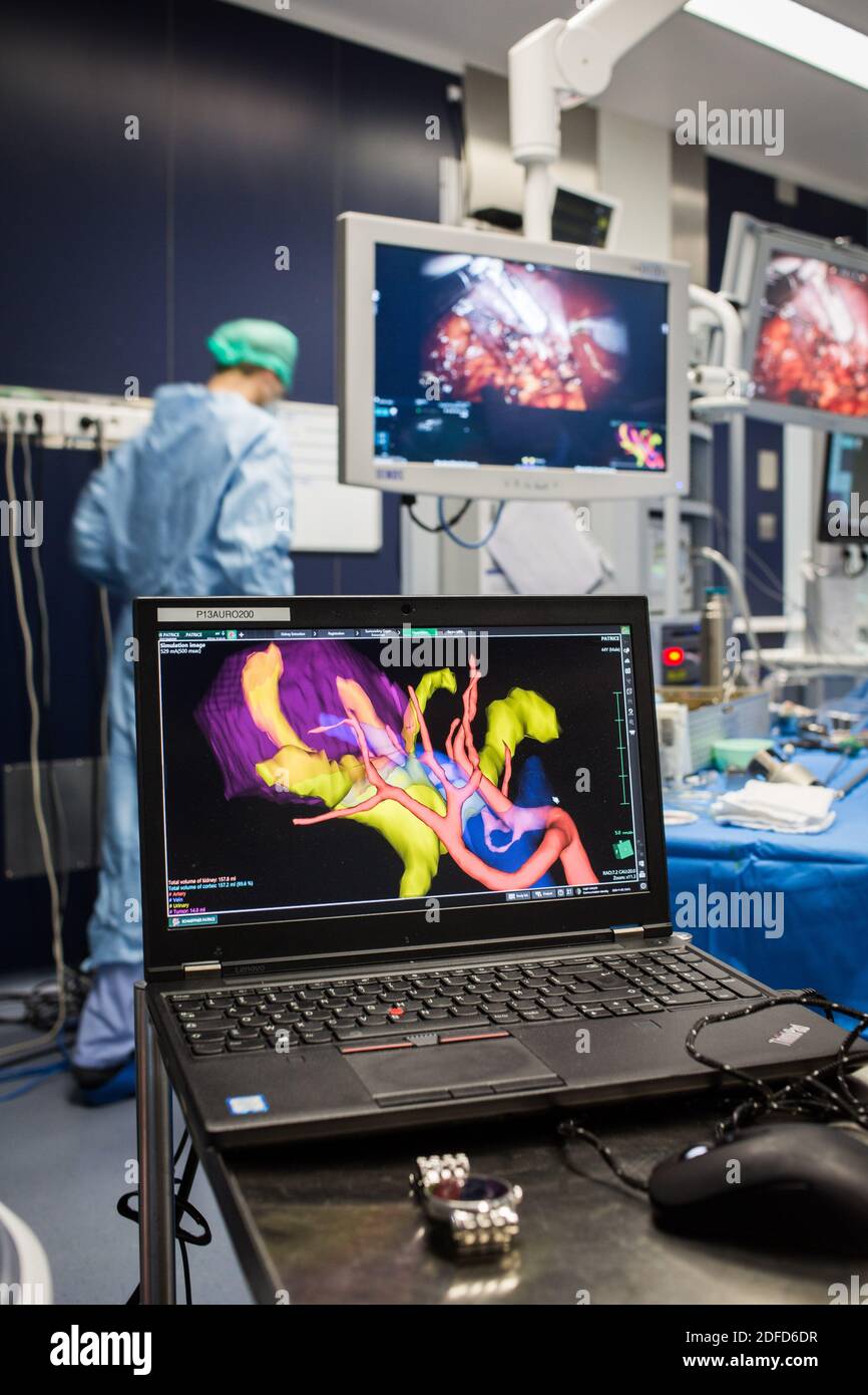 La chirurgie rénale conservatrice robotique guidée par l'image assistée par la modélisation 3D, cette modélisation 3D du rein avec sa tumeur située en violet, guide les s. Banque D'Images