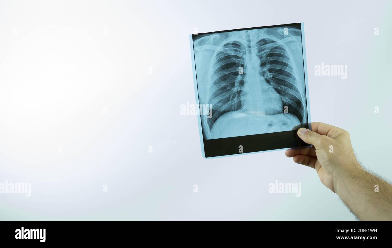 Radiographie d'un homme dans les mains d'un médecin sur fond blanc,un travailleur médical examine une maladie pulmonaire,un instantané de l'œdème pulmonaire,gros plan. Banque D'Images