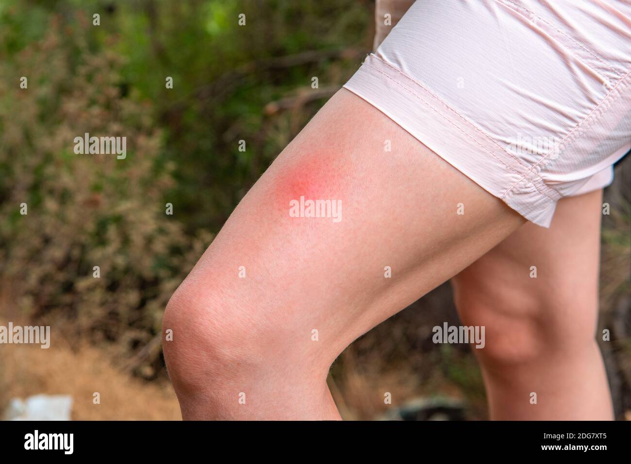 Piqûre d'insecte sur la jambe d'une femme. Une femme a été mordue par un insecte, une grande marque de morsure d'insecte rouge. En plein air dans la forêt. Concept de protection contre les insectes Banque D'Images