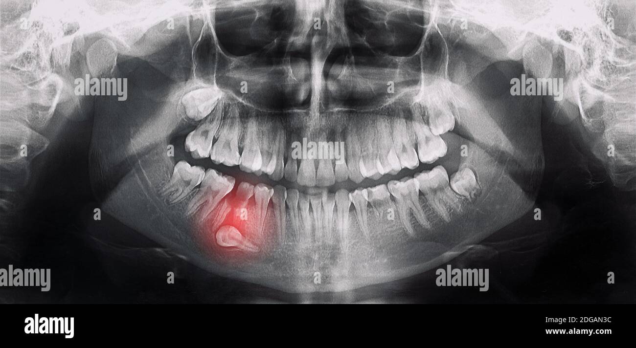 Orthopantomographie, OPG rayons X DR dents de sagesse numérique Banque D'Images