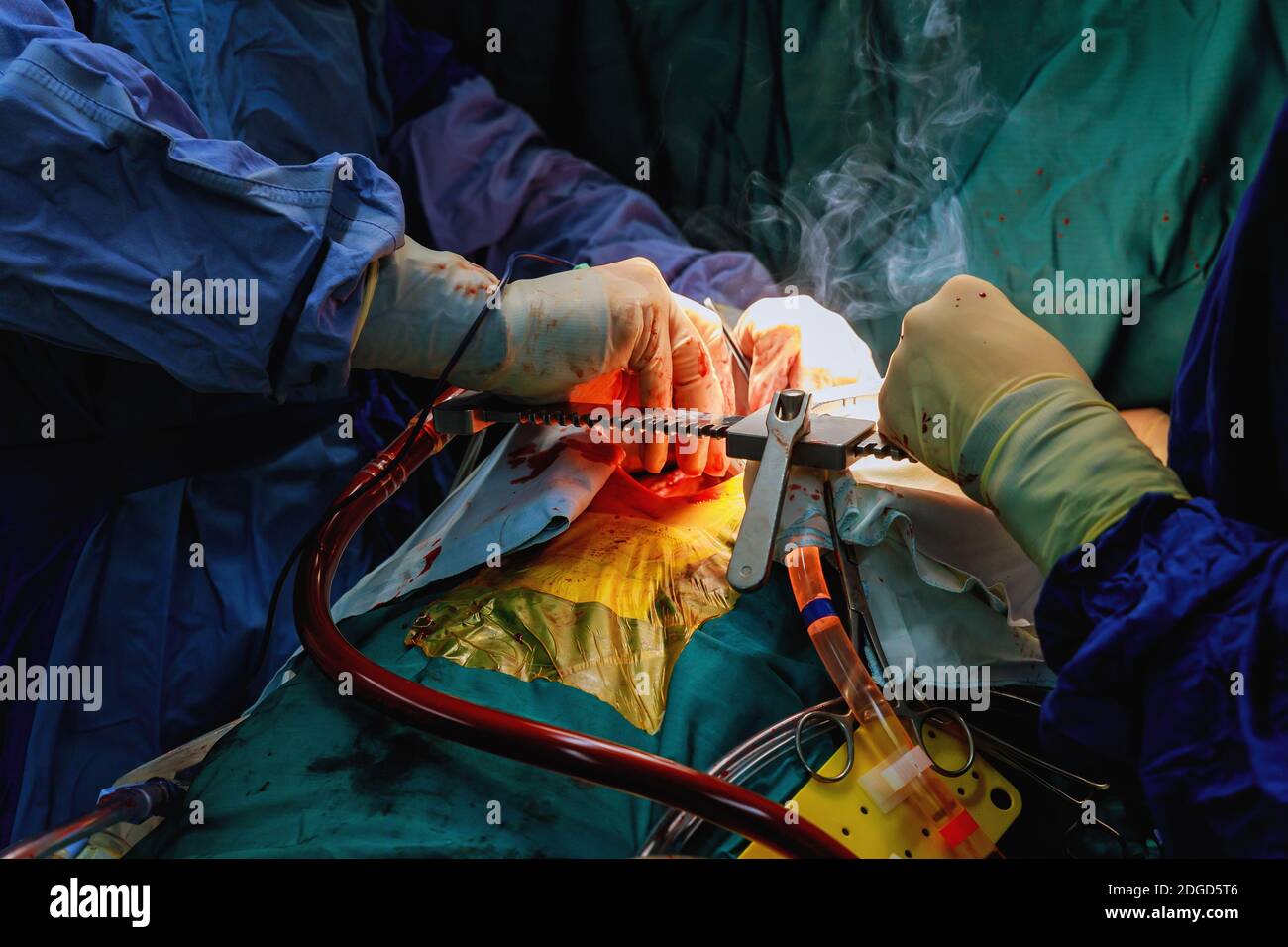 Chirurgie chirurgien de l'équipe et effectuer la chirurgie thoracique en cas de cancer du poumon Banque D'Images