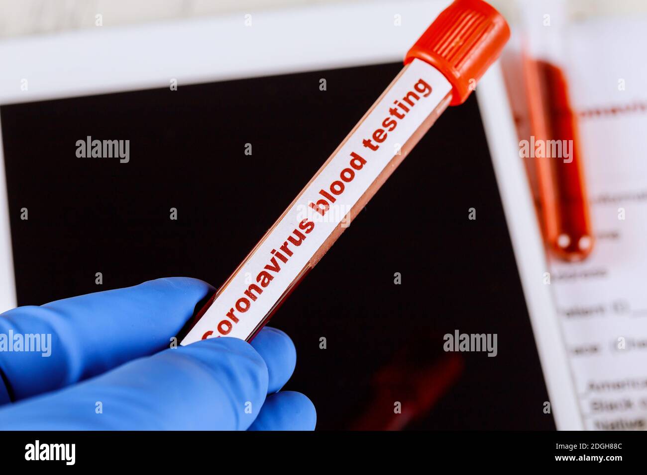 Test sanguin du virus de la pneumonie atypique du syndrome respiratoire du Moyen-Orient Banque D'Images