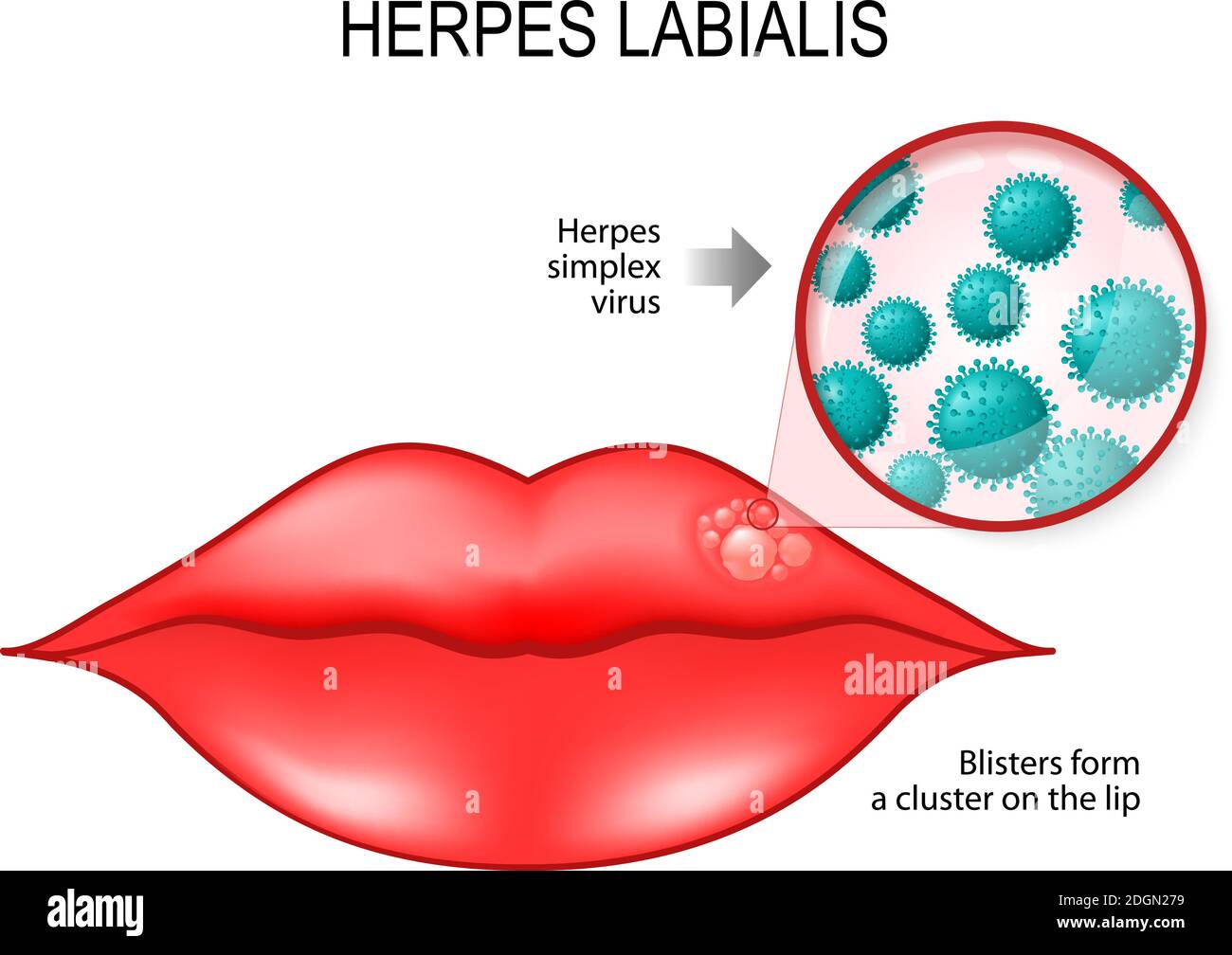Herpès labialis (cloques) sur la lèvre. Cause est le virus de l'herpès simplex (sous une loupe). Schéma vectoriel à usage médical Illustration de Vecteur