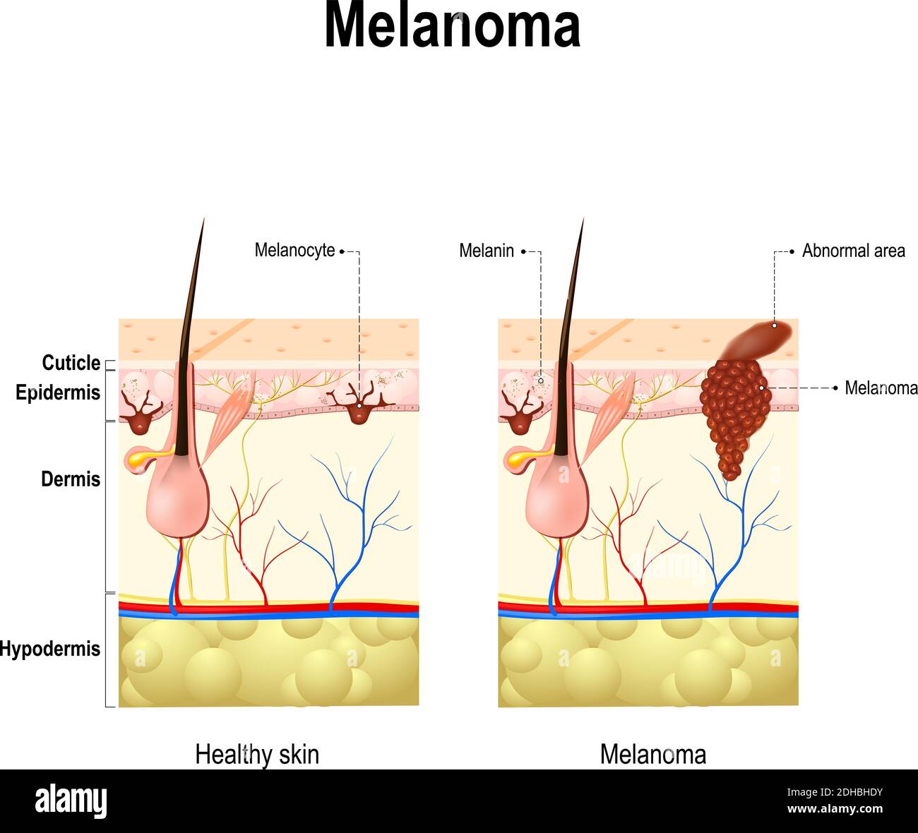 Mélanome ou cancer de la peau. Ce type rare de cancer de la peau provient des mélanocytes. Couches de la peau humaine. Illustration de Vecteur
