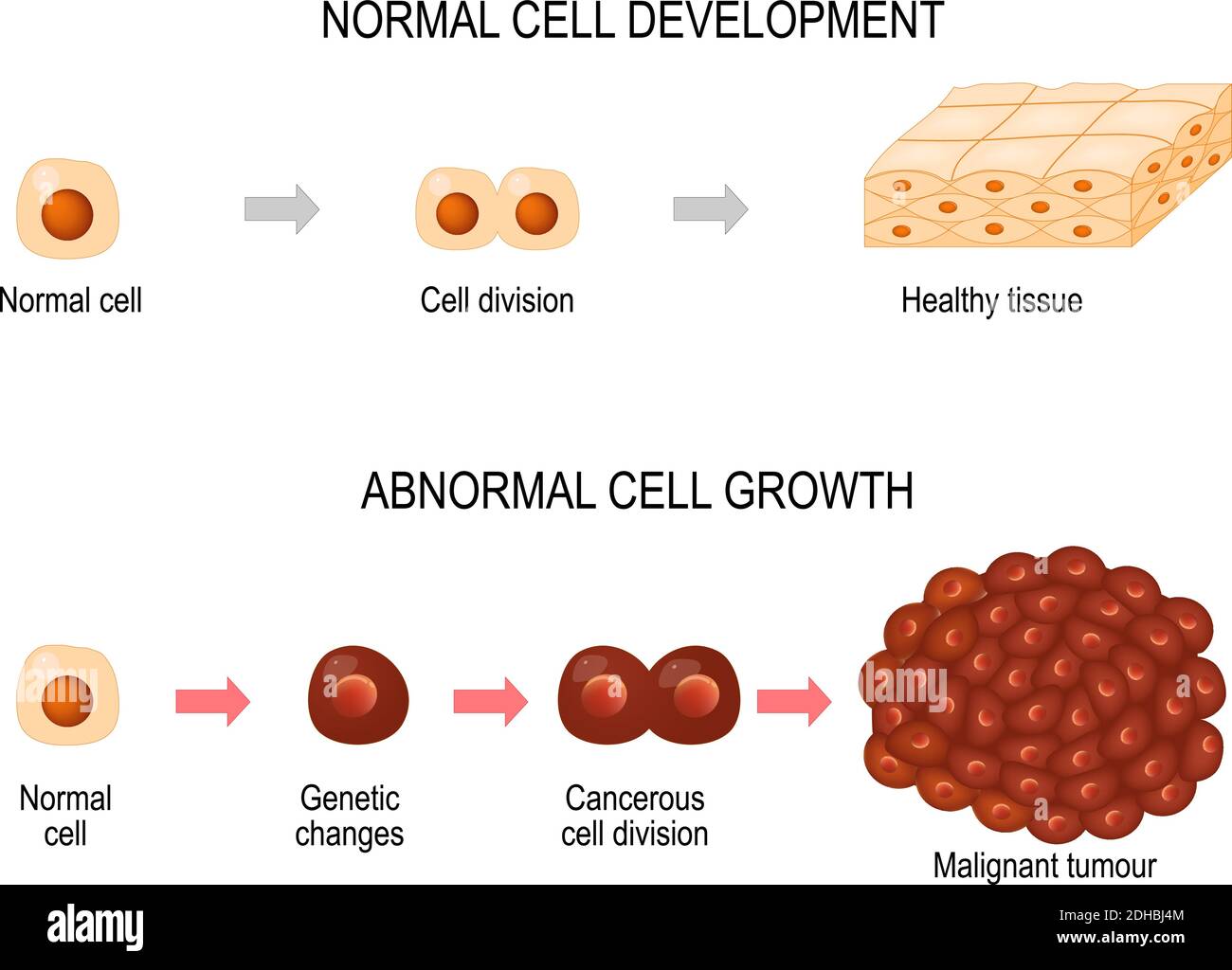 Cellules cancéreuses. Illustration montrant le développement de la maladie du cancer. Tissu sain et tumeur maligne. Schéma vectoriel pour votre conception, éducatif Illustration de Vecteur