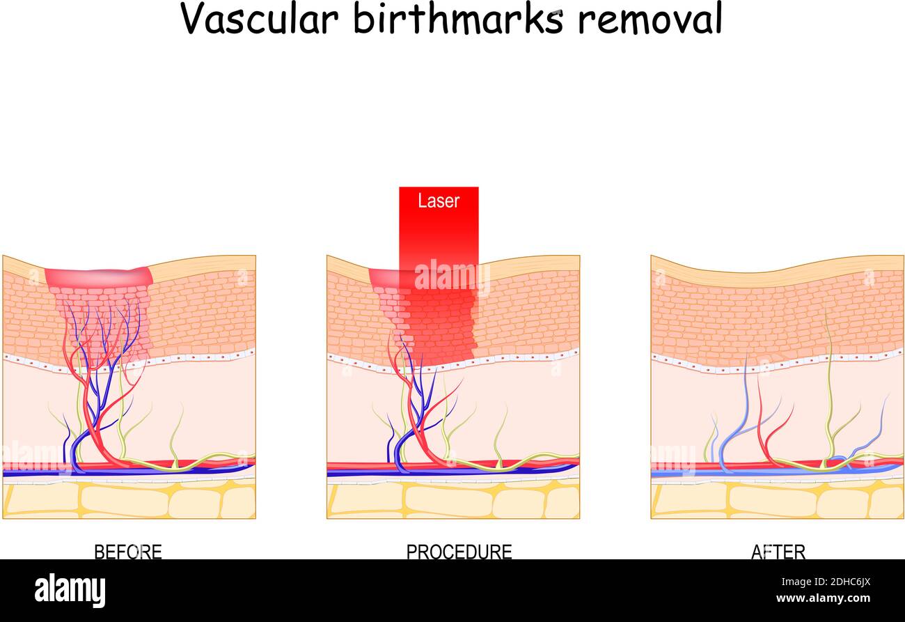 Suppression des marques de naissance vasculaires. Avant et après la procédure de traitement. Chirurgie au laser pour la peau Illustration de Vecteur