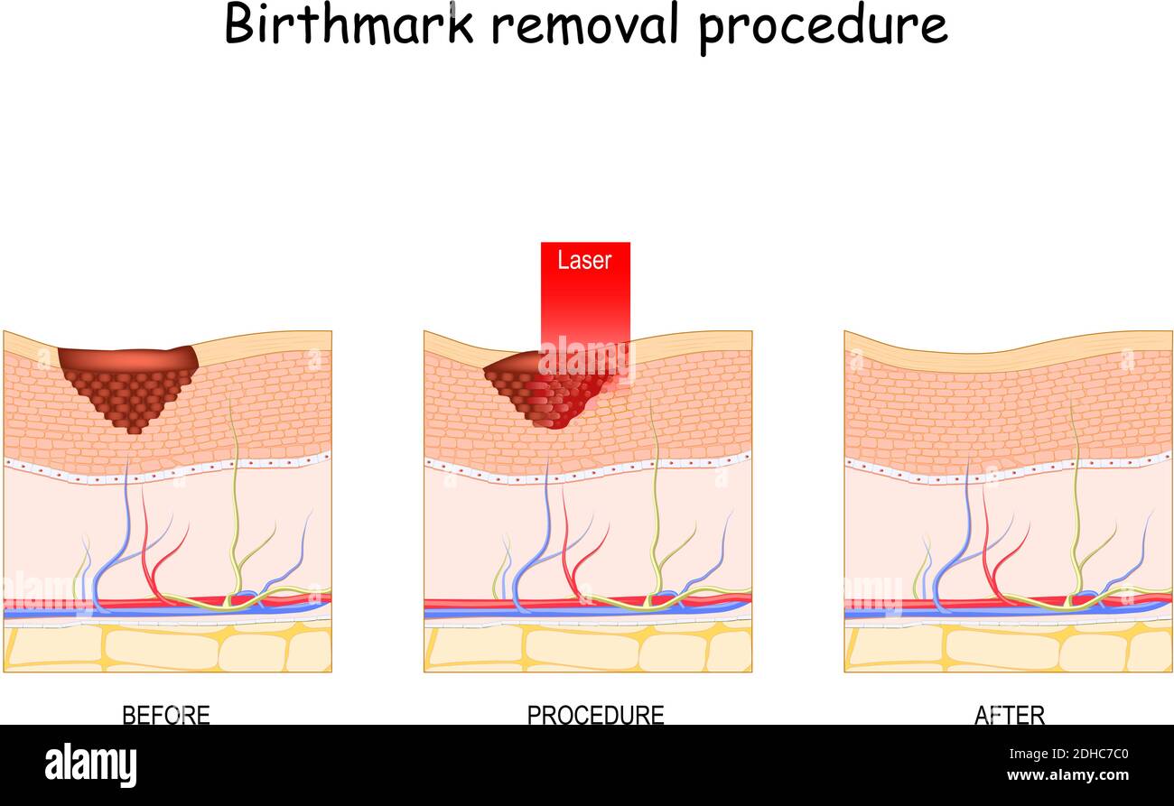 Suppression du laser de marque de naissance. Traitement. Avant et après la procédure Illustration de Vecteur