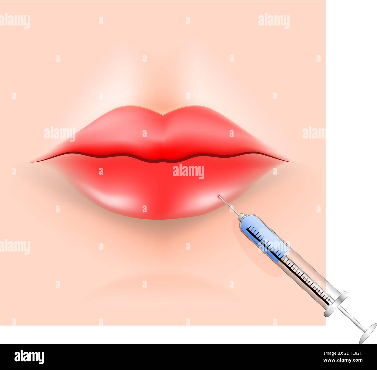 Augmentation de la lèvre. Procédure d'insection des lèvres. Mastic cosmétique injectable. Illustration vectorielle à usage biologique, scientifique et médical. Illustration de Vecteur