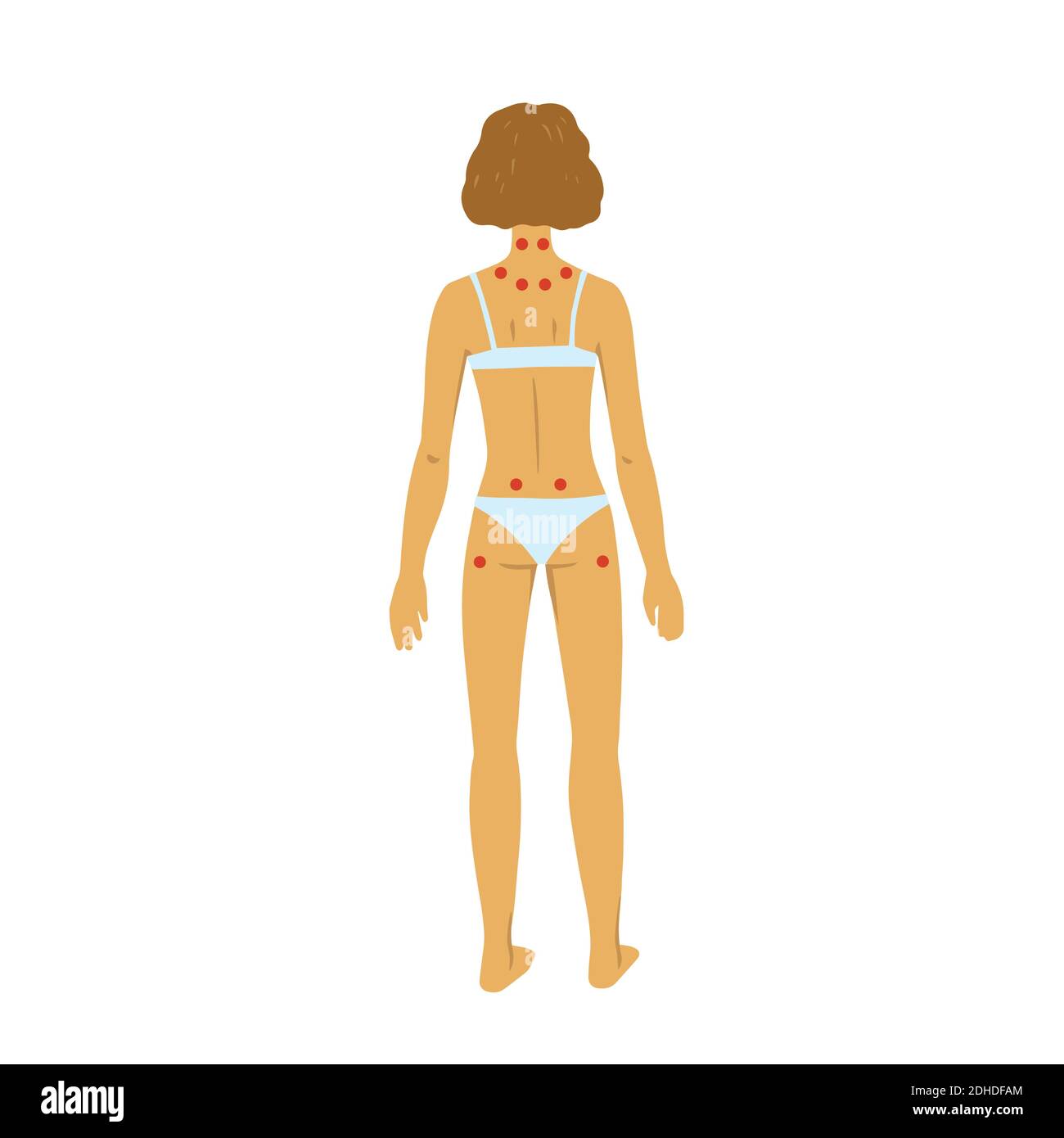 Points d'appel d'offres de fibromyalgie. Illustration vectorielle du corps de la femme sur fond blanc. Illustration de Vecteur