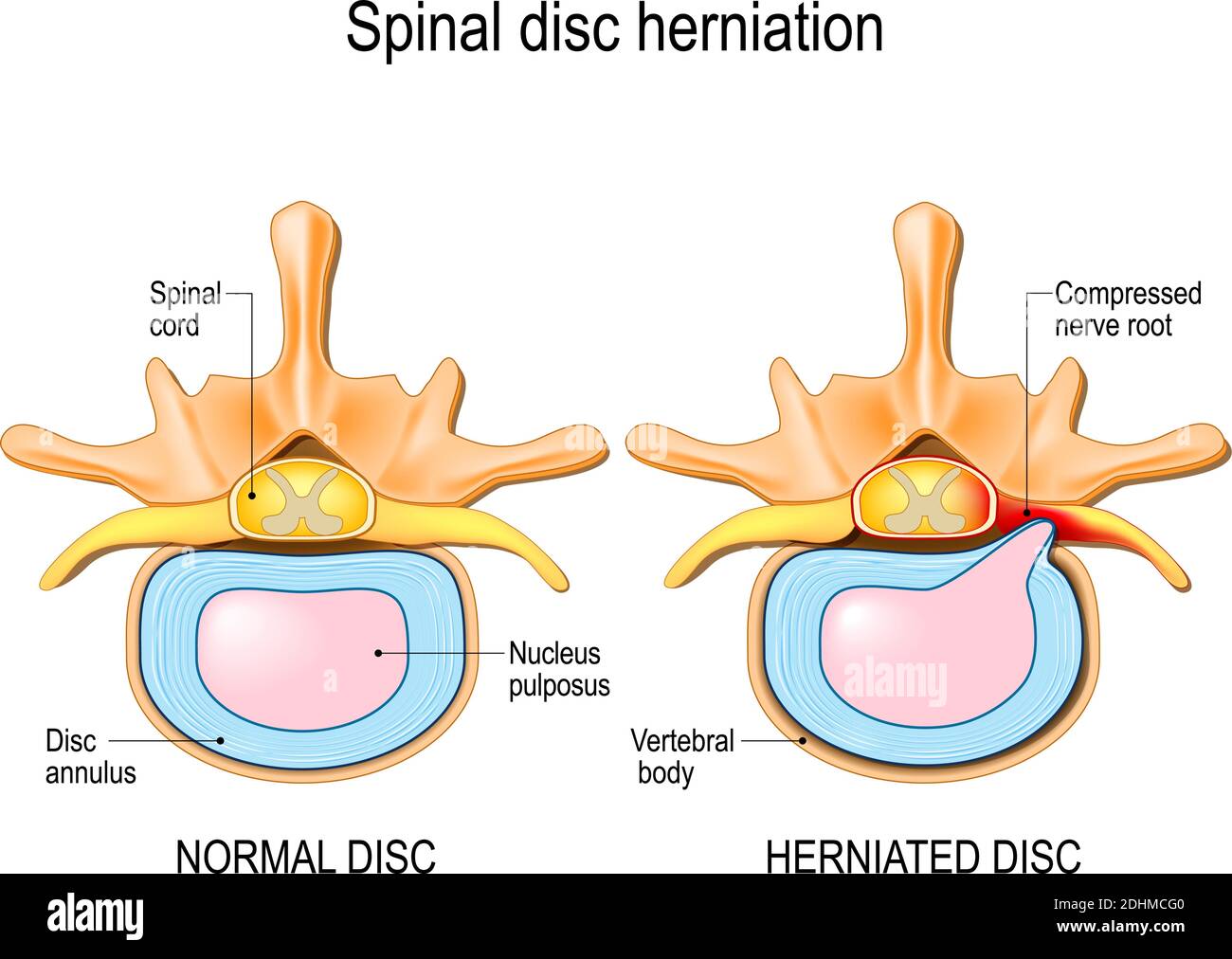 Hernie médullaire. Douleurs dorsales. Hernie à disque normal et à disque spinal dans les vertèbres cervicales. Illustration vectorielle Illustration de Vecteur