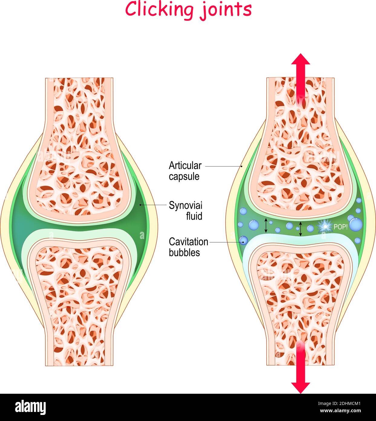 Joints et bruit de claquement. Mécanisme physiologique de cavitation manipuler le joint nous allons obtenir le son c'est le mouvement rapide des bulles de gaz Illustration de Vecteur