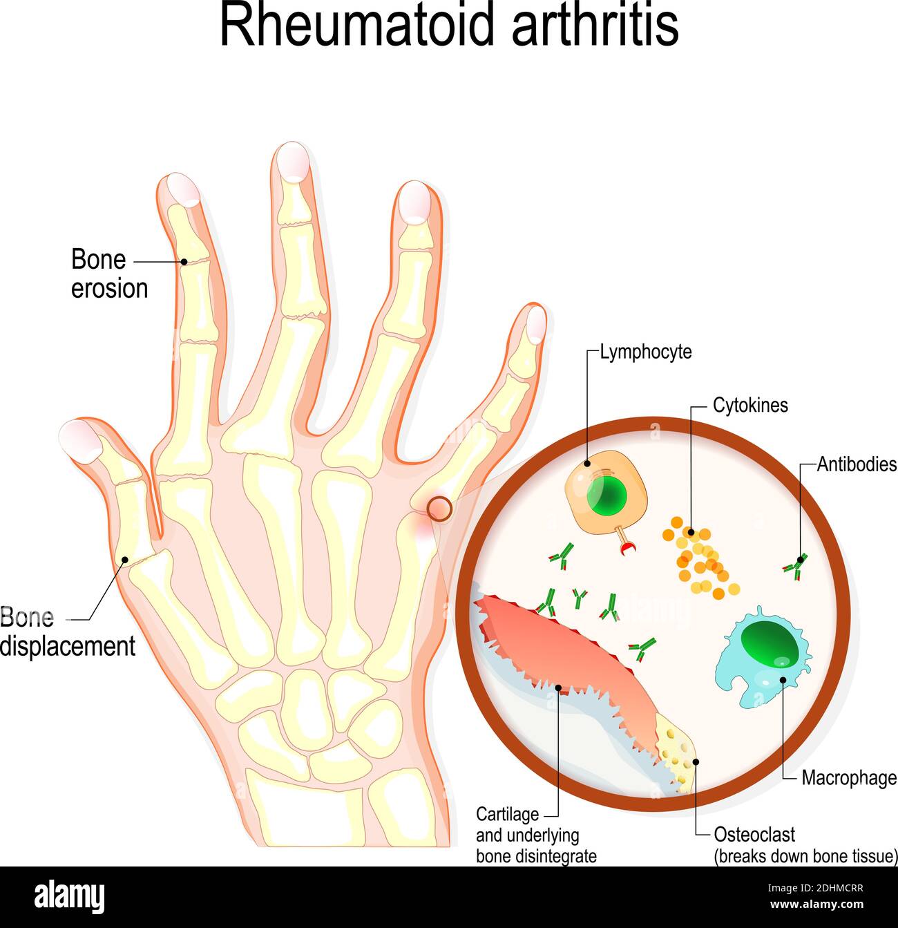 La polyarthrite rhumatoïde (PR) est une maladie auto-immune et un type inflammatoire de l'arthrite qui affecte habituellement les articulations. Main avec la polyarthrite rhumatoïde Illustration de Vecteur