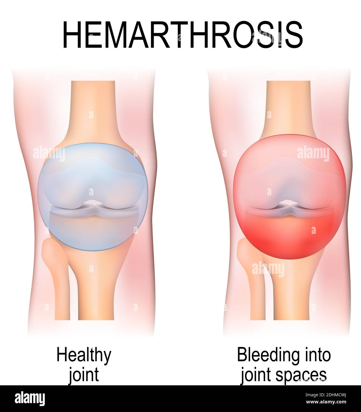 L'hémarthrose (hémarthrose) est un saignement dans les espaces articulaires. Anatomie humaine. Deux articulations du genou : en bonne santé et avec blessure Illustration de Vecteur