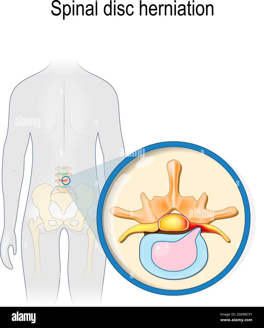 Hernie médullaire. Douleurs dorsales. Silhouette humaine avec rachis lombaire et bassin en surbrillance (couleur rouge). Prolapsus du disque intervertébral en gros plan Illustration de Vecteur