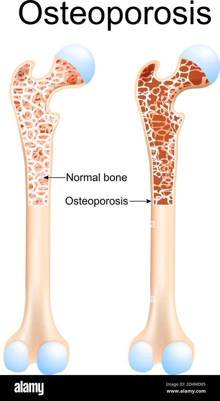 L'ostéoporose - est une maladie des os qui entraîne un risque accru de fracture. Fémur et os sains avec Ostéoporose Illustration de Vecteur