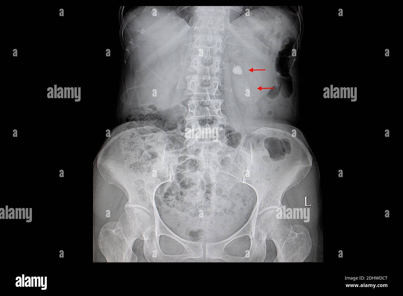 Film radiographique d'un patient avec une grande pierre dans le bassin rénal droit et calcification dans le pôle inférieur du rein. Banque D'Images