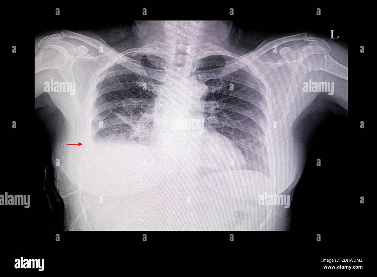 Film radiographique thoracique d'une patiente présentant une cardiomégalie, un œdème pulmonaire et un épanchement pleural du poumon droit. Banque D'Images