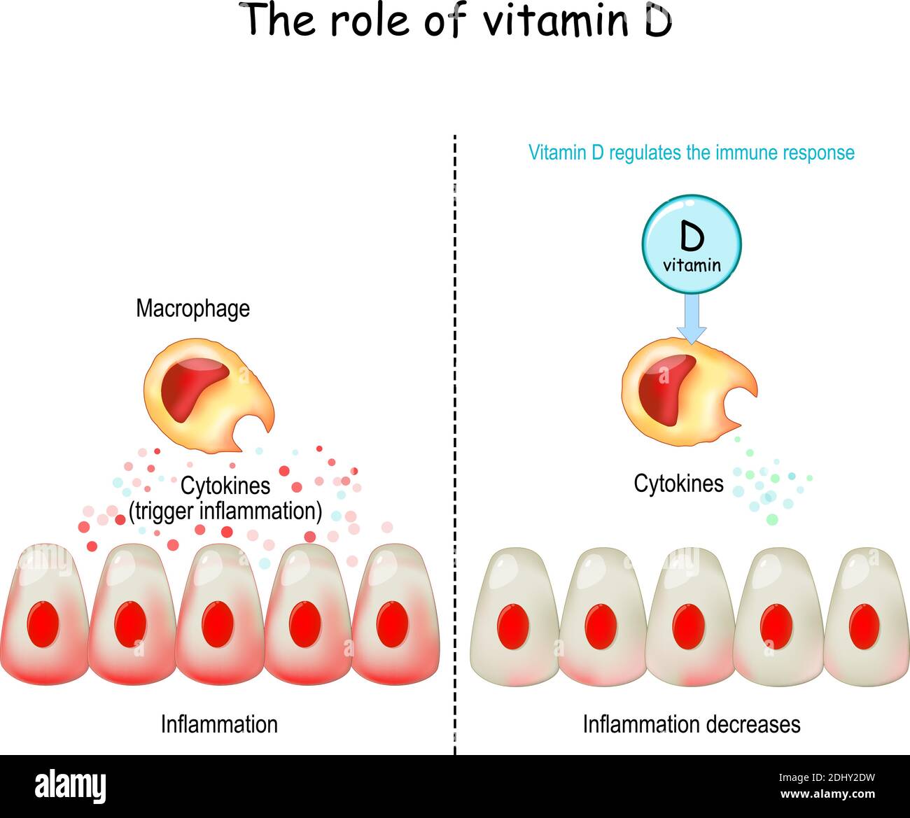 Vitamine D, système immunitaire et COVID-19. La vitamine D régule la réponse immunitaire. Tempête de cytokine. COVID-19 complications. Différence et comparaison Illustration de Vecteur