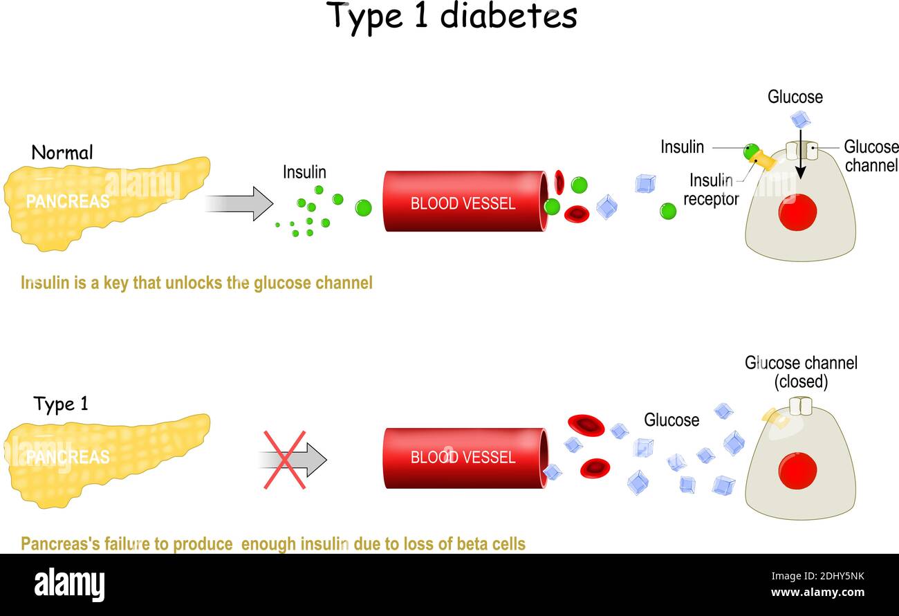 Types 1 de diabète sucré. L'incapacité du pancréas à produire suffisamment d'insuline en raison de la perte de cellules bêta Illustration de Vecteur