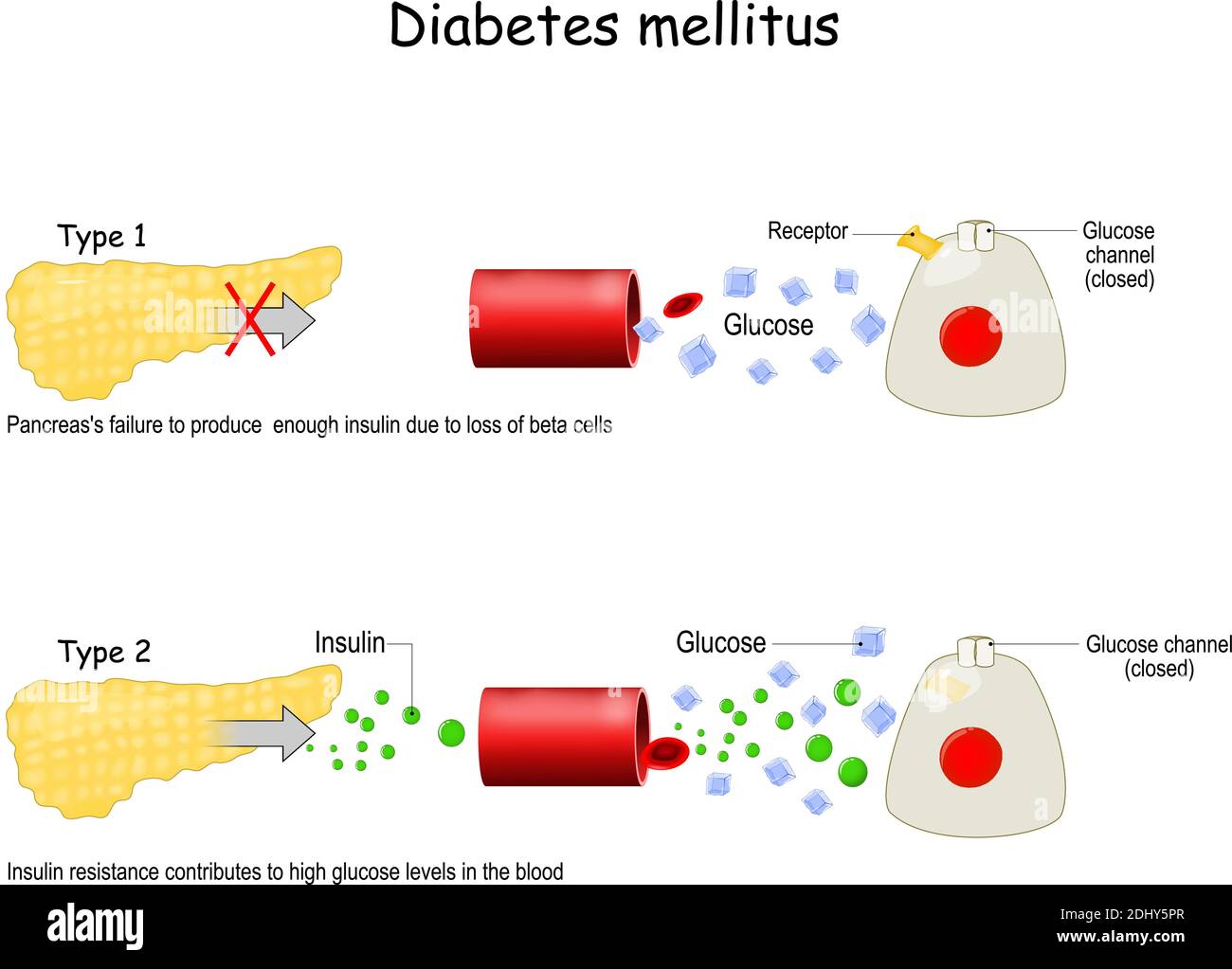 Types de diabète sucré. Illustration de Vecteur