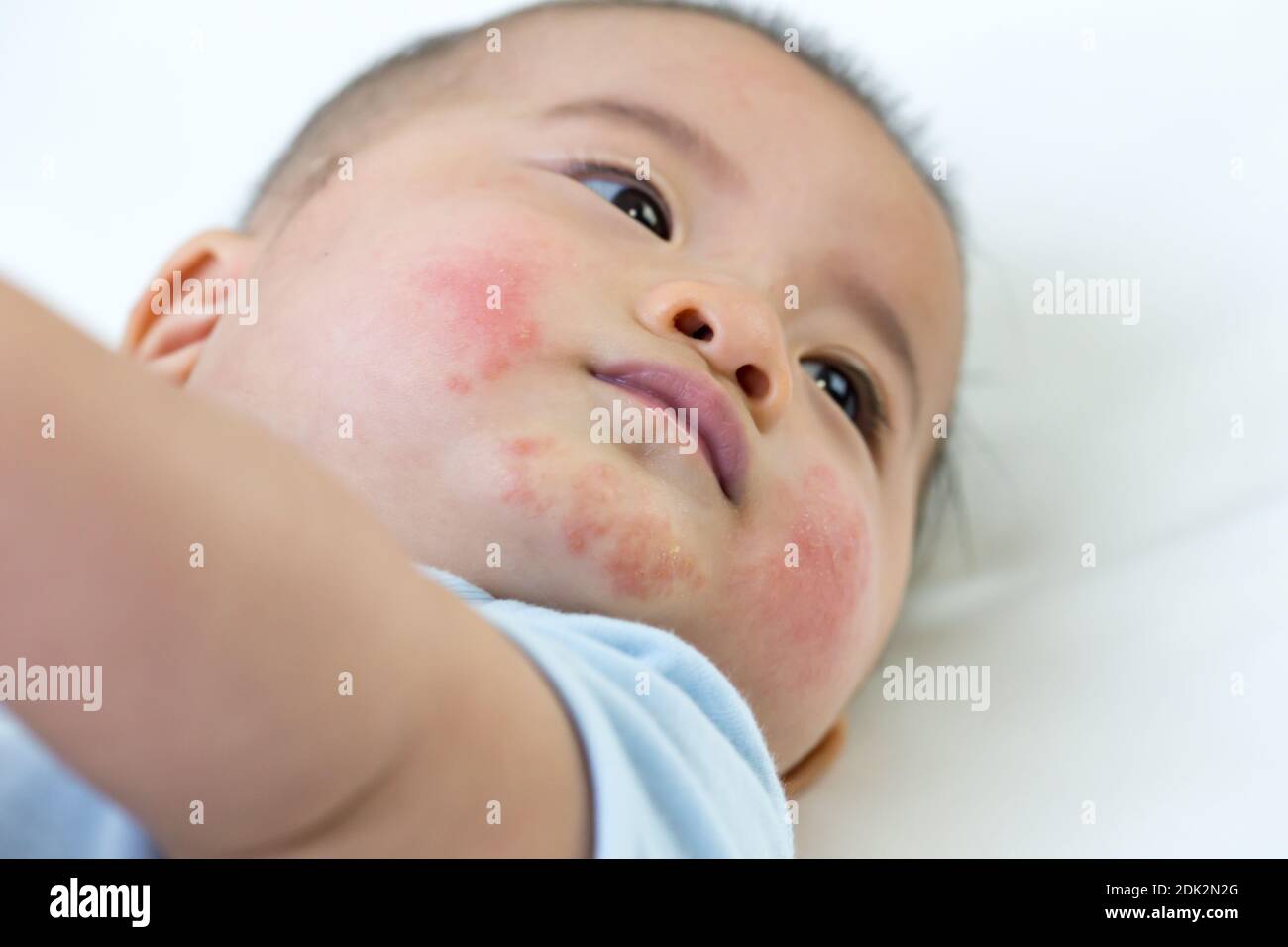 Gros plan de bébé garçon mignon avec allergie de peau couché sur le lit  Photo Stock - Alamy