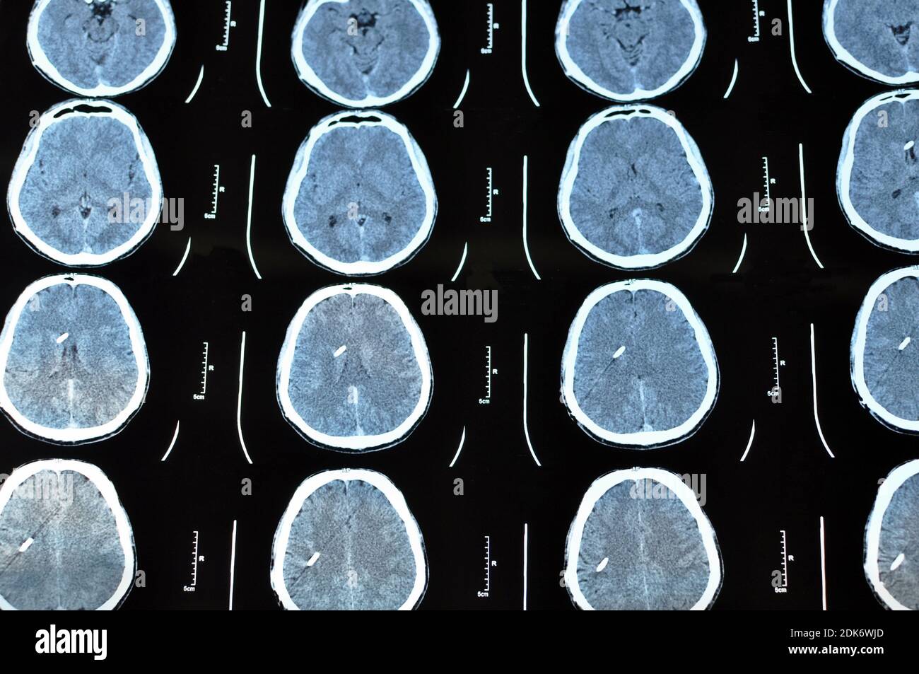 Acquisition d'images tomographiques du cerveau. Film CT d'un crâne et d'un cerveau humains avec shunt intracrânien. Antécédents de neurologie. Médecine, science. Banque D'Images