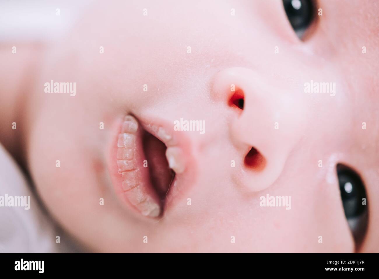 Le Nouveau Ne Est Sec Levres Gercees Craque Rugueux Bouche Seche Erostomia Photo Stock Alamy