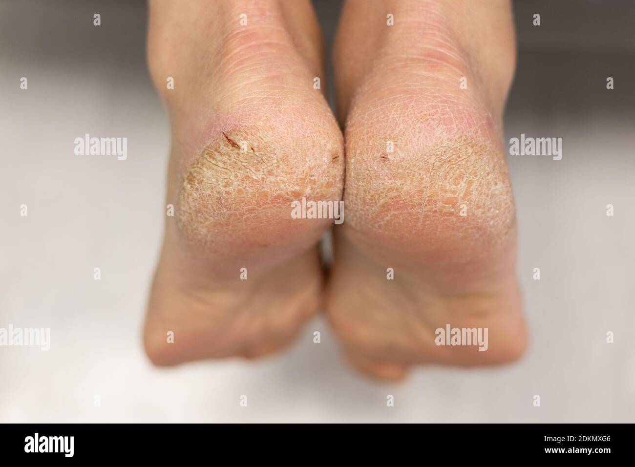 Craques de callus sanglants sur un pied de talon de semelle de près. Problème de dermatologie de la peau sèche Banque D'Images