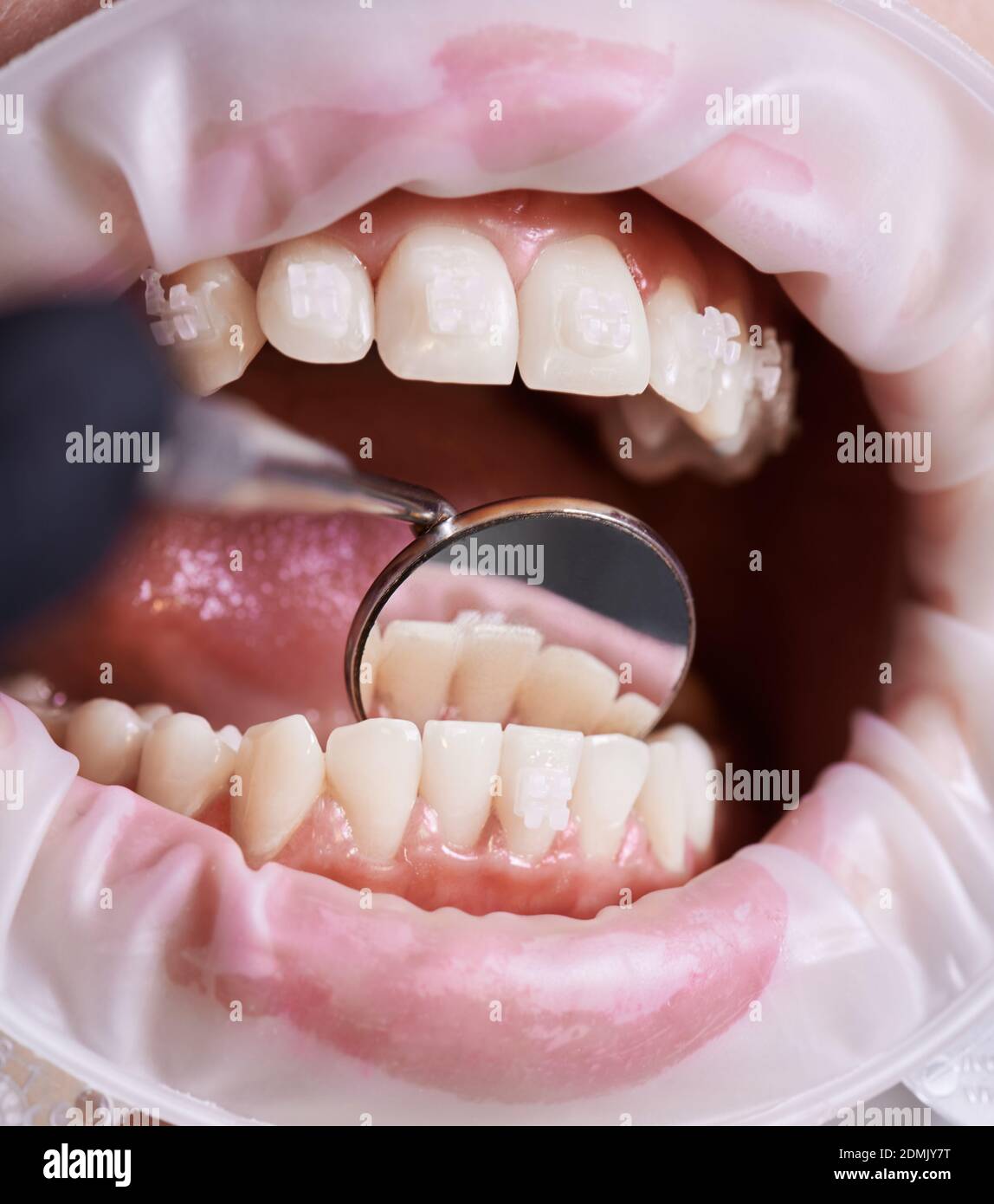 Marco instantané de la main du dentiste vérifiant les dents inférieures du  patient à l'aide d'un miroir. Vue avant des belles dents blanches avec  supports en céramique pendant la procédure dentaire. Enrouleur