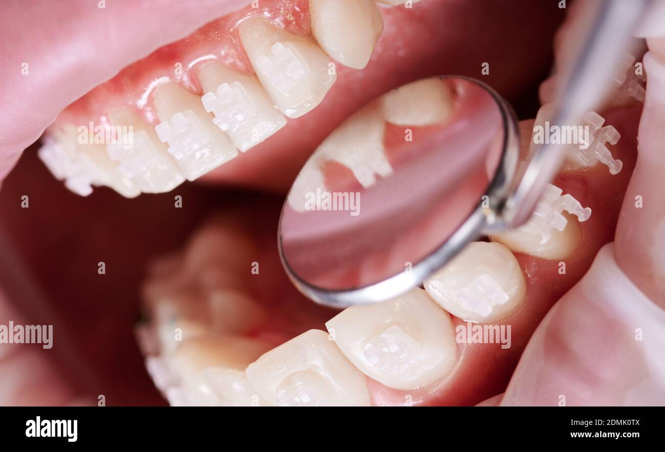 Gros plan de l'orthodontiste vérifiant les dents et les bretelles du patient à l'aide d'un miroir dentaire. Personne ayant un rétracteur de joue dans la bouche et des supports sur les dents ayant une intervention dentaire en clinique. Concept de soins de santé Banque D'Images