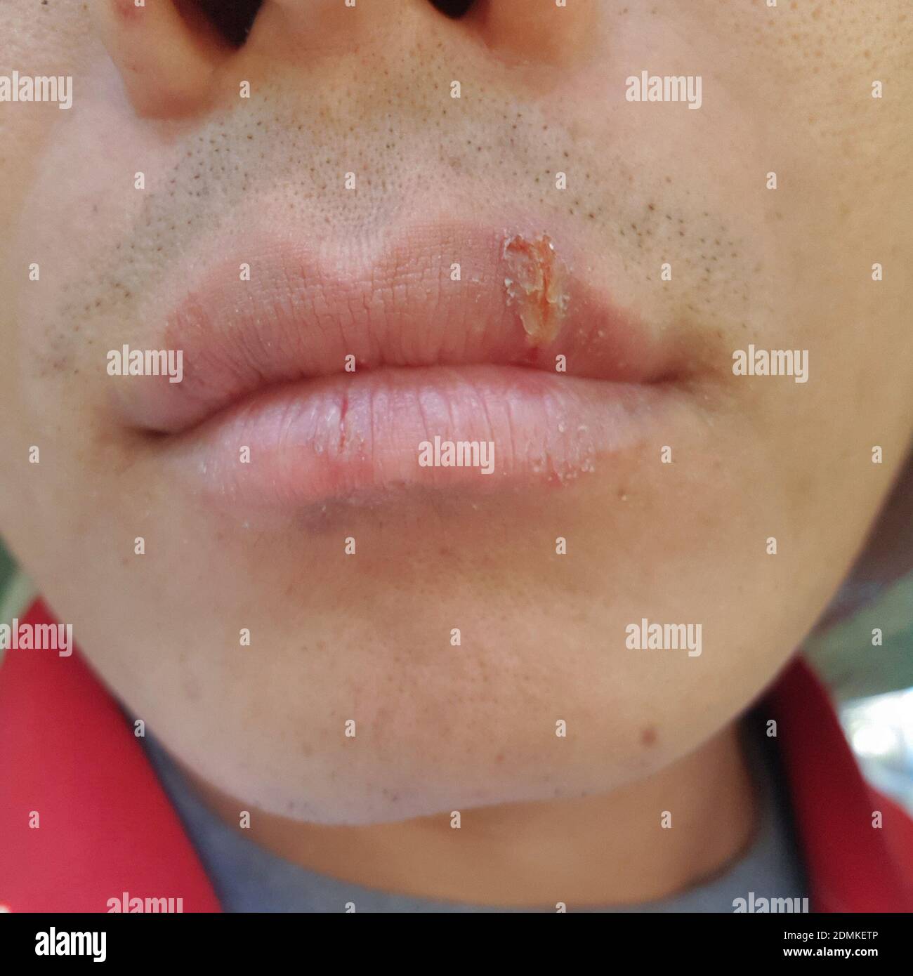 Gros plan de l'homme aux lèvres gercées Photo Stock - Alamy