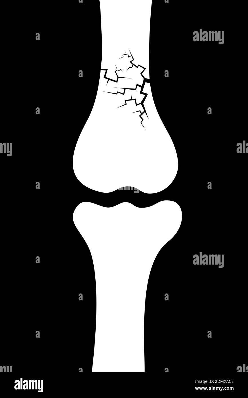 Fracture osseuse - fissures et détérioration du squelette - lésion et maladie. Illustration vectorielle. Banque D'Images