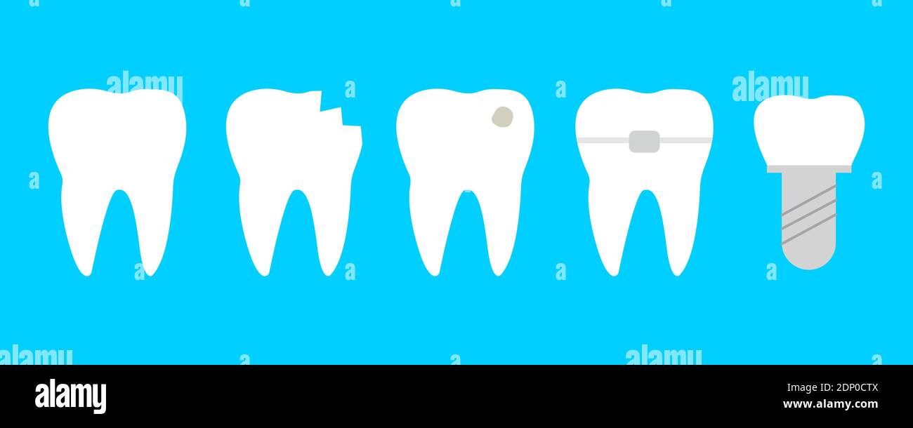 Dents avec différentes maladies. Dent saine, craquelée, broken, avec caries, orthodontiques et implant dentaire Illustration de Vecteur