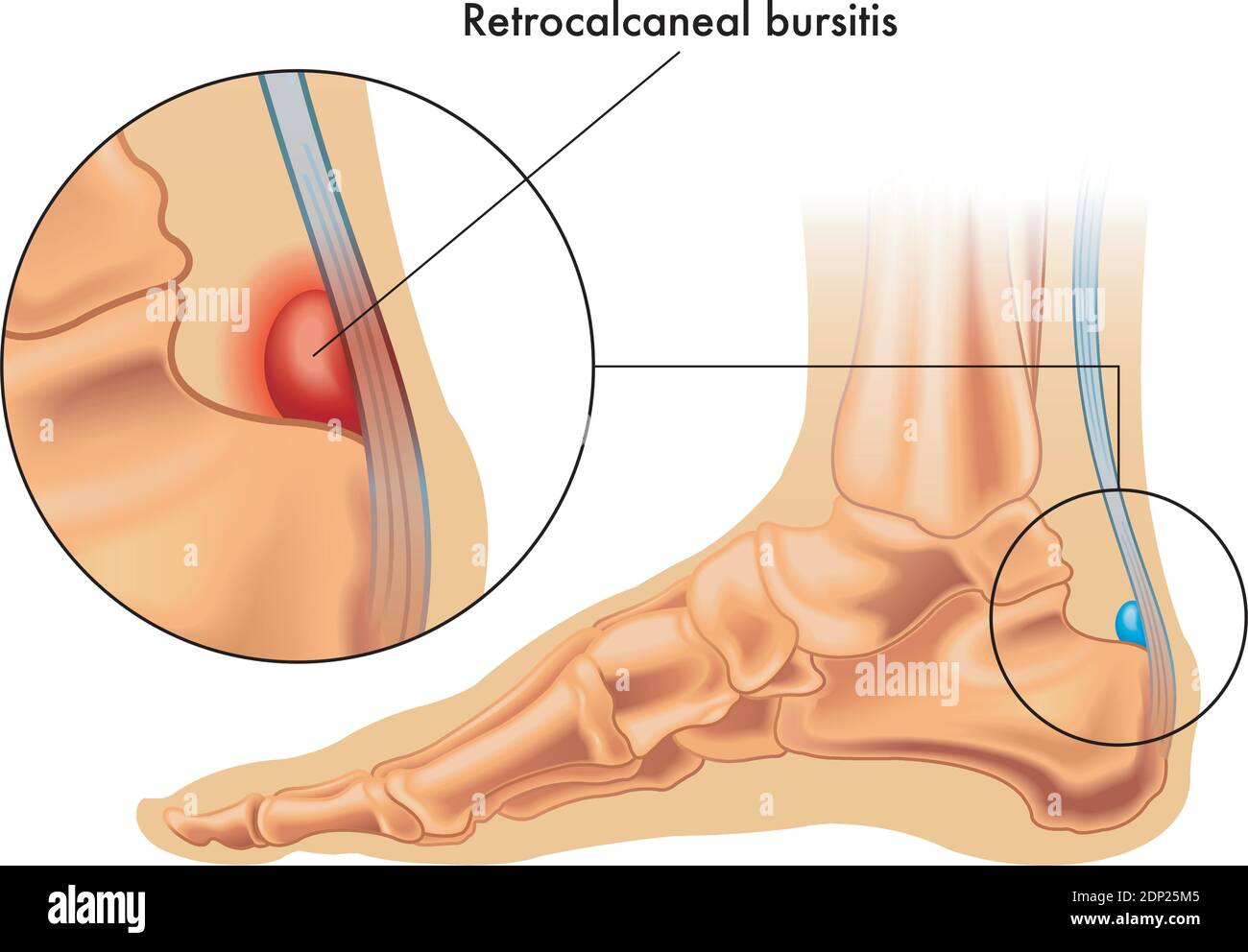 Illustration montrant la position de la bursa rétrocalcanéale normale dans le pied, et en gros plan une bursite rétrocalcanéale, annotée sur blanc Illustration de Vecteur