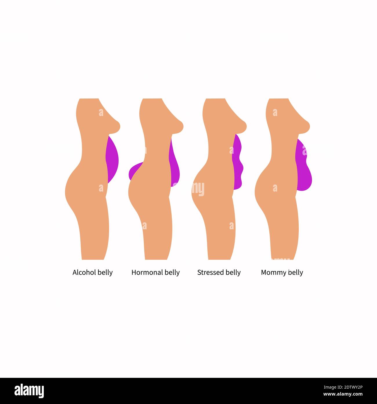 Différents types et causes d'obésité abdominale chez les femmes Image  Vectorielle Stock - Alamy
