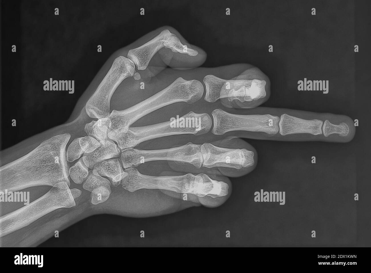 Radiographie du doigt moyen d'un patient de l'hôpital Banque D'Images