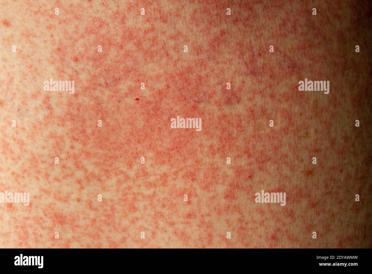 Une réaction allergique (effet secondaire) à la pénicilline (amoxicilline) sur la peau d'un homme blanc de 51 ans à Londres, Royaume-Uni. Banque D'Images