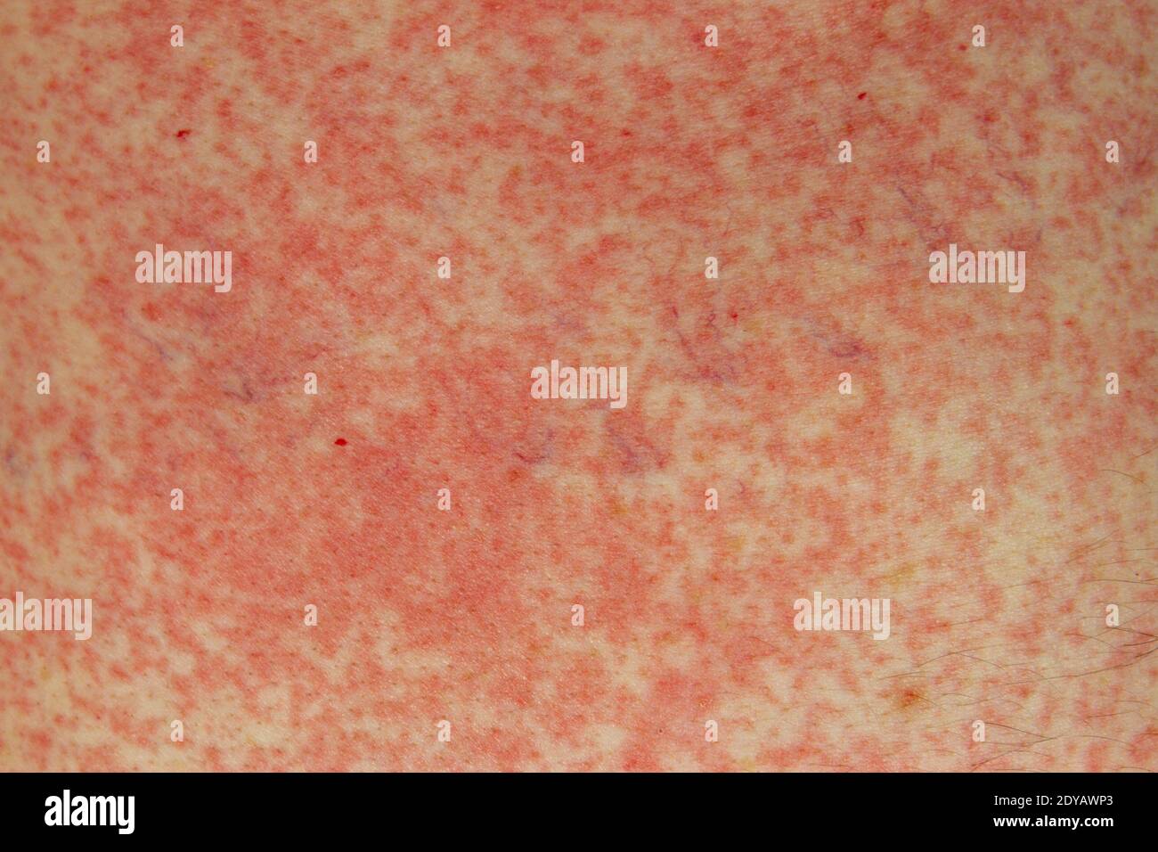 Une réaction allergique (effet secondaire) à la pénicilline (amoxicilline) sur la peau d'un homme blanc de 51 ans à Londres, Royaume-Uni. Banque D'Images