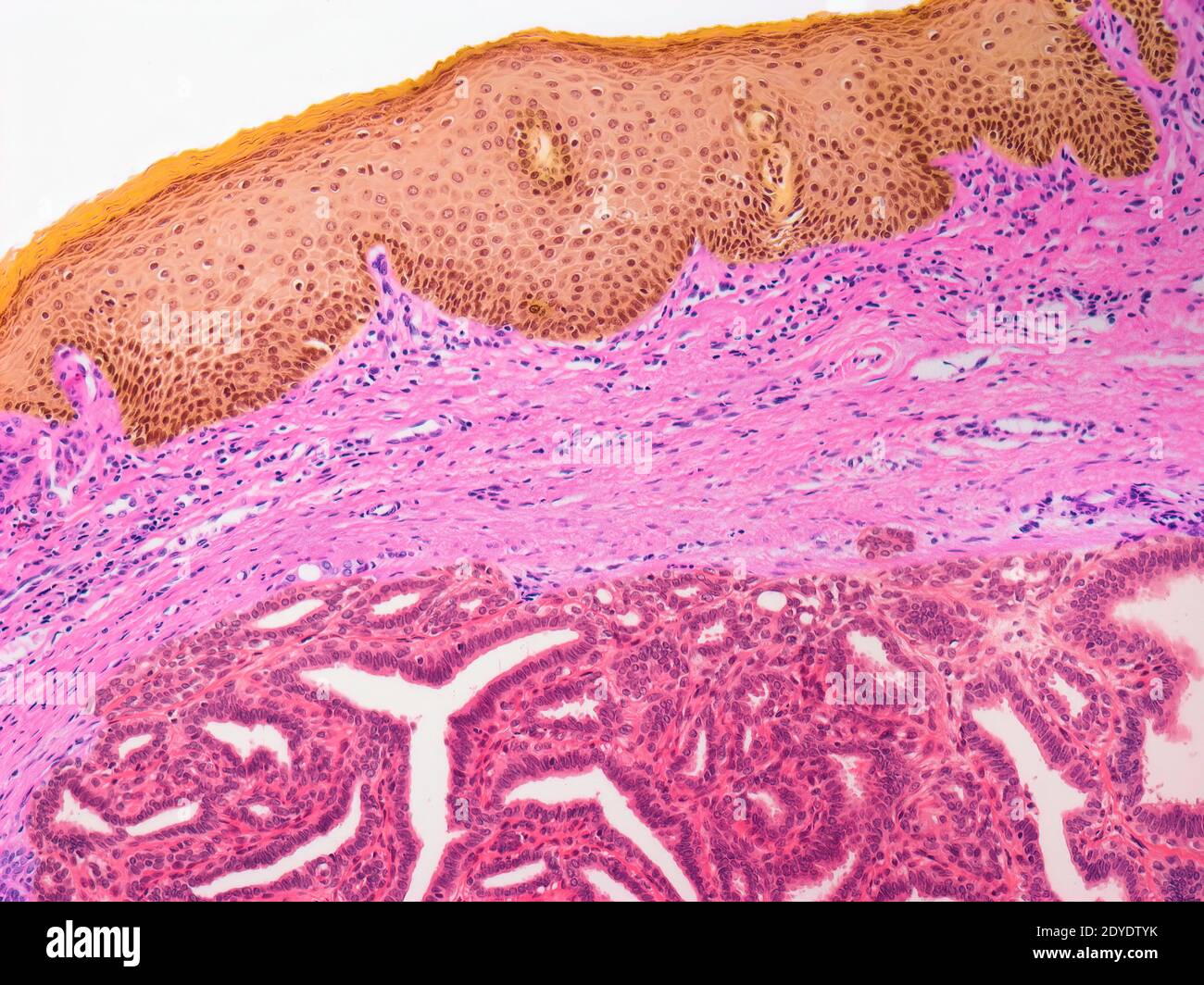 Hidradenoma papilliferum, micrographe léger (LM) d'une section de vulve atteinte. Banque D'Images