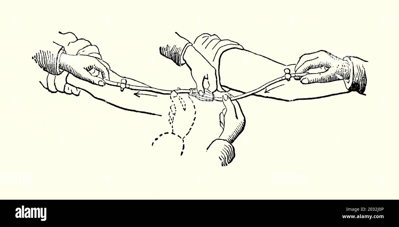 Une vieille gravure de l'appareil de transfusion de sang victorien. Il est tiré d'un livre d'ingénierie mécanique des années 1880. Ce dispositif (l’«appareil de transfusion directe» d’Aveling) nécessite l’insertion d’un tube en argent dans une veine donneuse (à droite). Le sang est forcé dans la veine du patient (à gauche) en pressant la poire en caoutchouc au centre de l’appareil. L'obstétricien britannique J H Aveling a inventé son système en 1872. La transfusion sanguine est le processus de transfert de sang ou de produits sanguins dans sa circulation intraveineuse. Les transfusions précoces ont utilisé du sang total. Banque D'Images