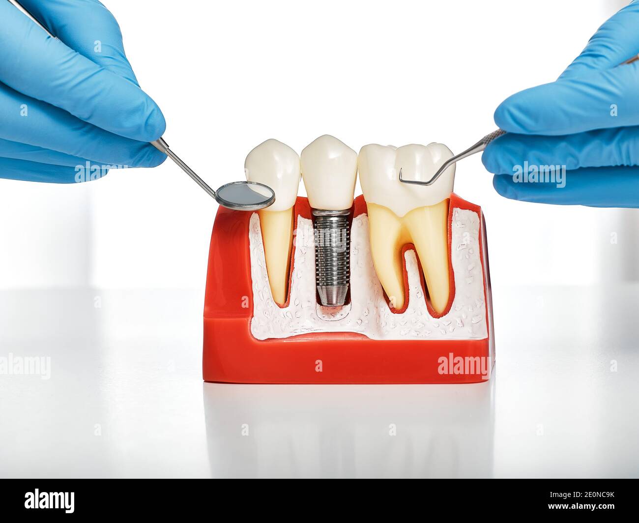 Notion : prothèses dentaires. Montrant l'installation d'un implant dentaire sur le modèle anatomique des dents, en gros plan Banque D'Images