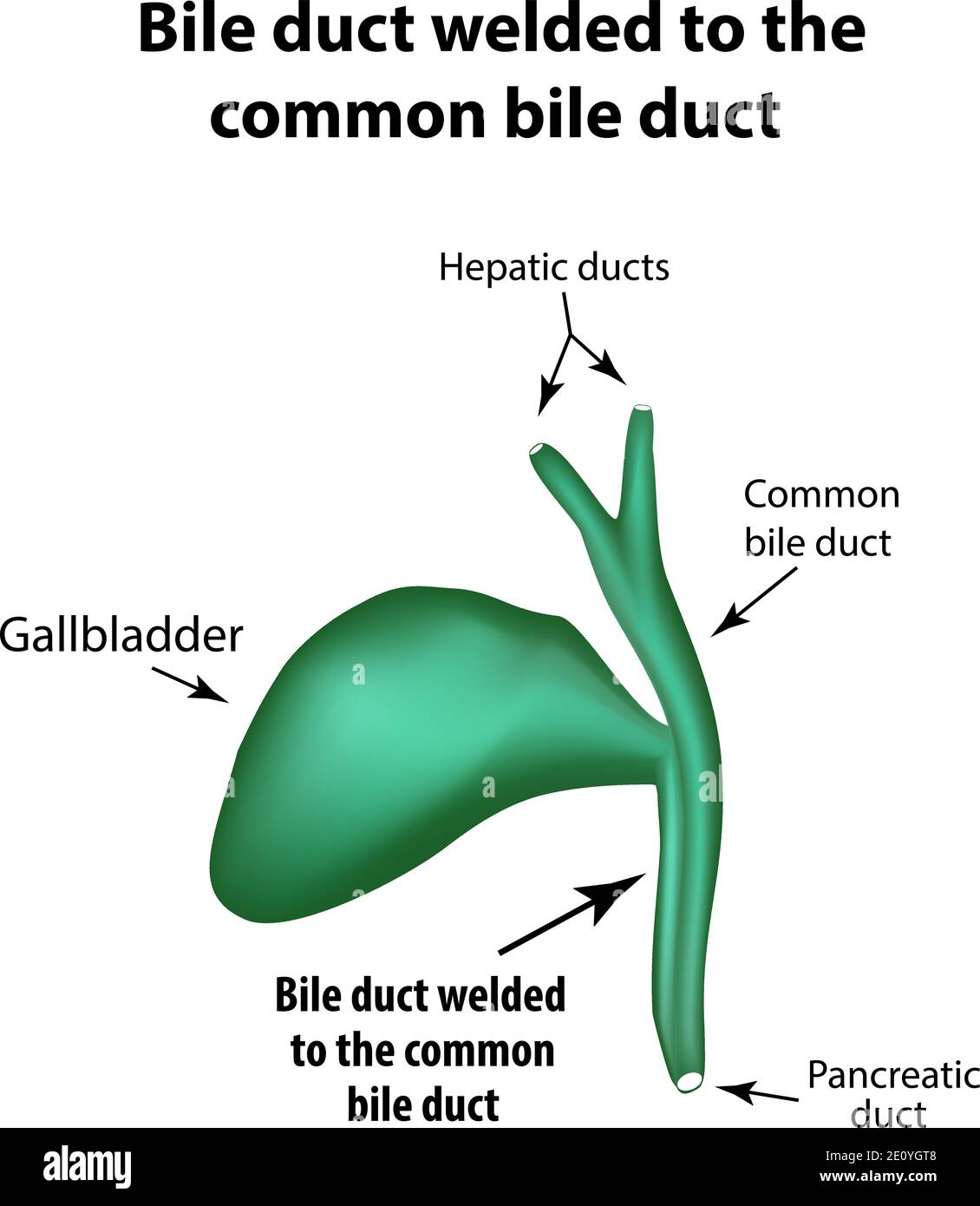 Canal biliaire soudé au canal biliaire commun. Pathologie de la vésicule biliaire. Cholécystite. La structure de la vésicule biliaire. Infographies. Vecteur Illustration de Vecteur