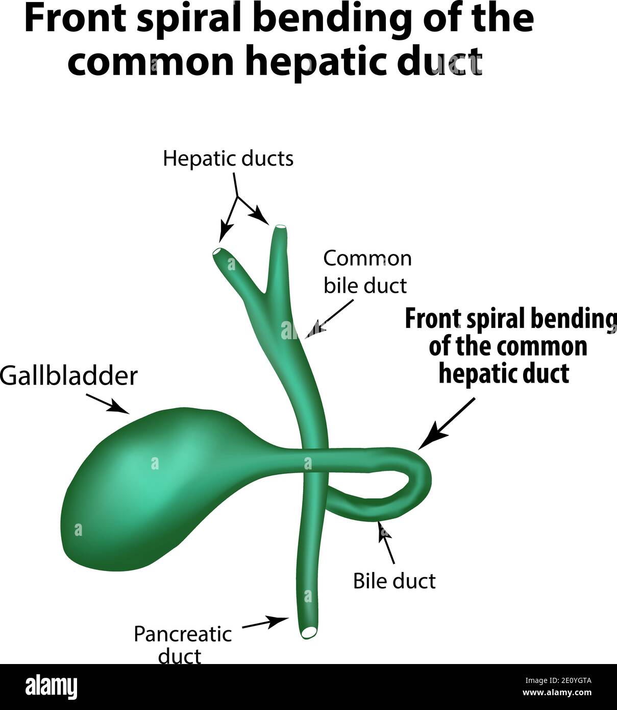 Flexion en spirale avant du canal hépatique commun. Pathologie de la vésicule biliaire. Cholécystite. La structure de la vésicule biliaire. Infographies. Vecteur Illustration de Vecteur