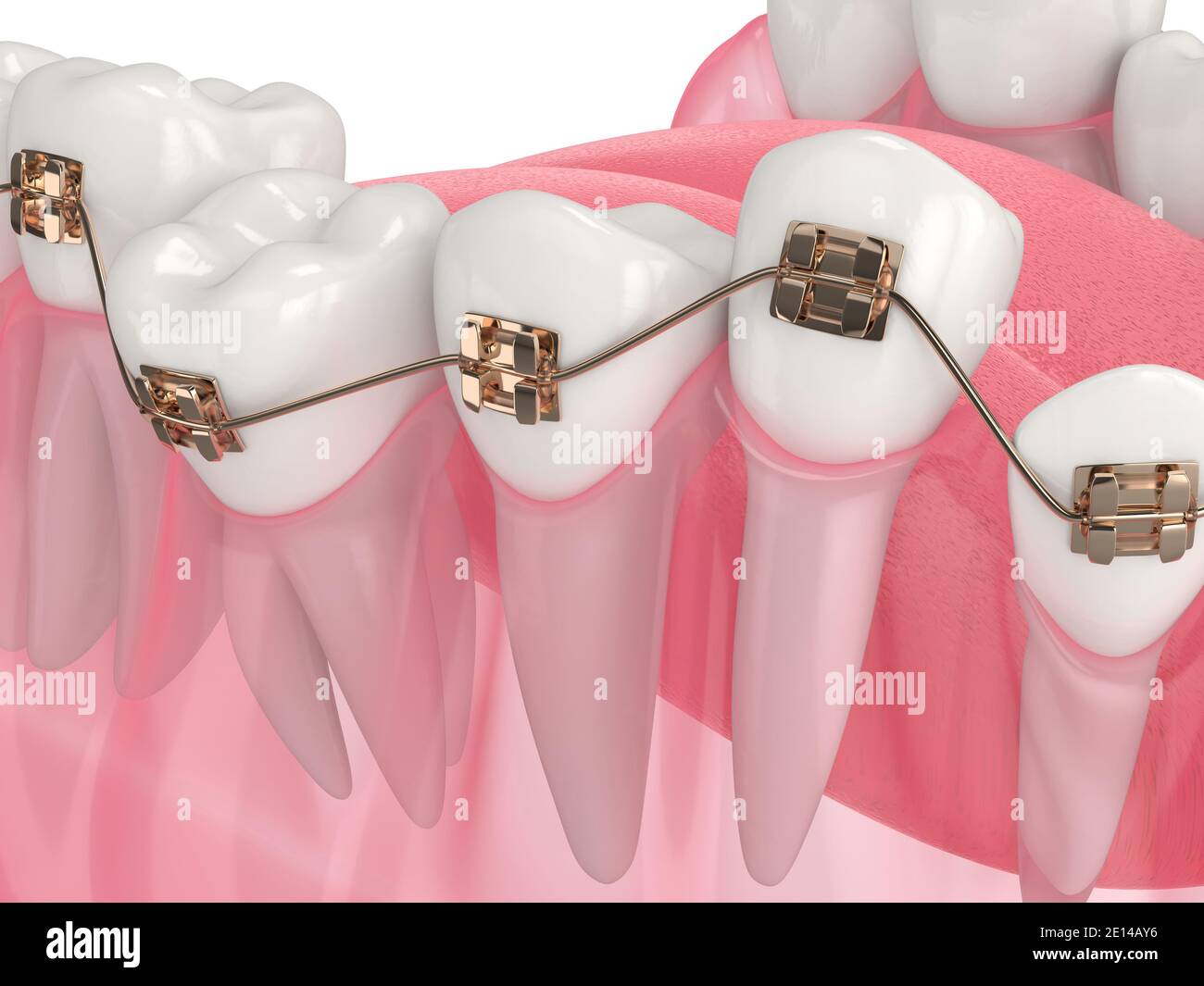 rendu 3d de l'alignement des dents par des accolades orthodontiques sur du blanc Banque D'Images