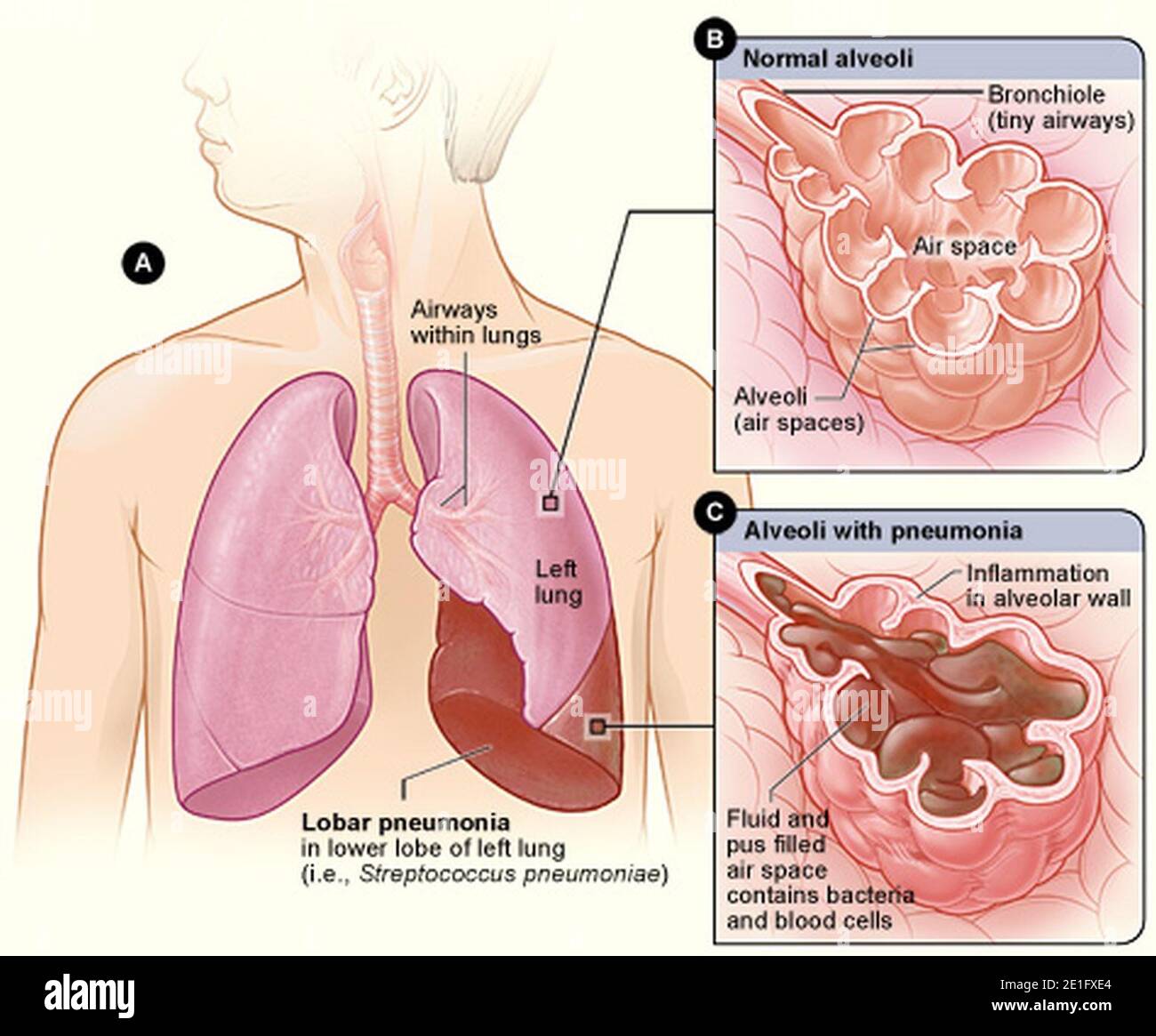 Pneumonie lobar illustrée. Banque D'Images