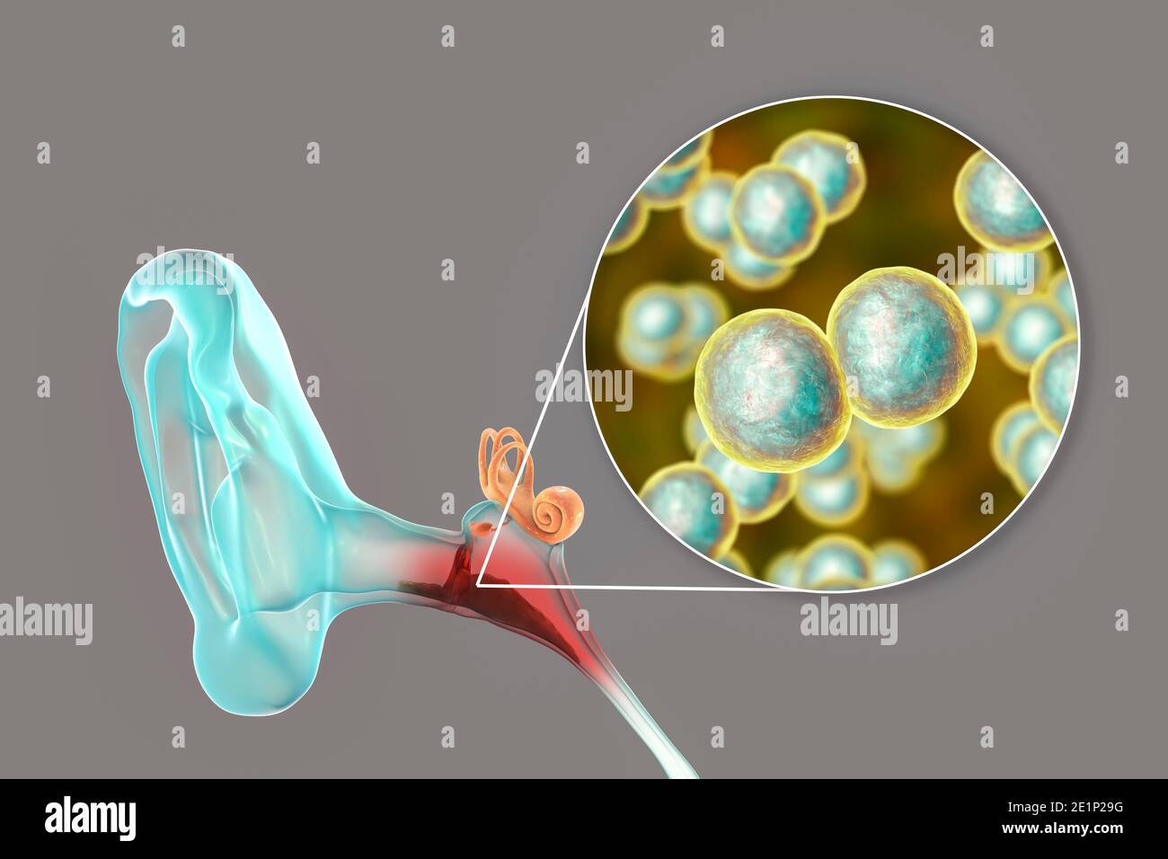 Infection de l'oreille du milieu de l'otite, illustration Banque D'Images