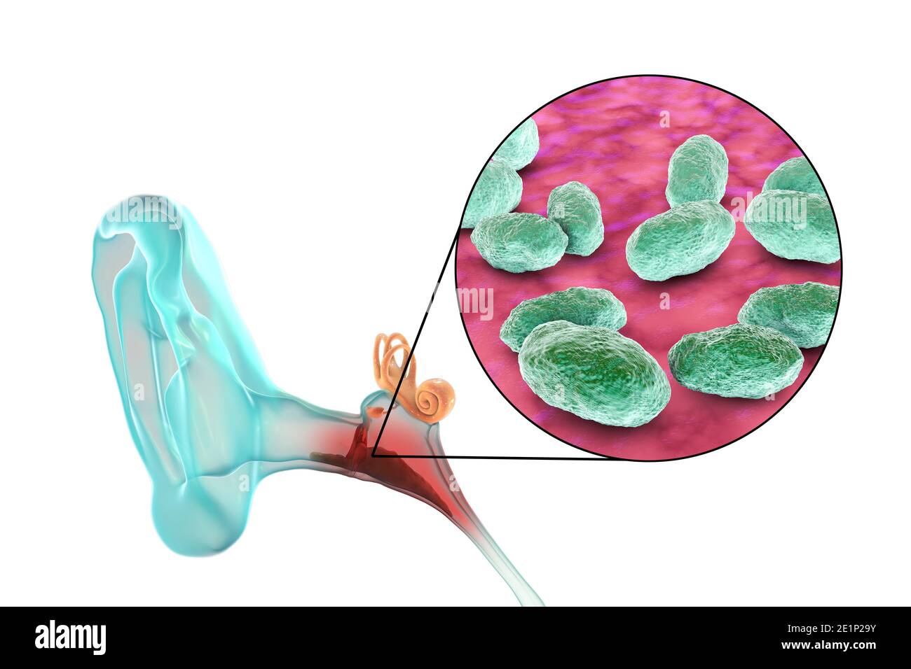 Infection de l'oreille du milieu de l'otite, illustration Banque D'Images