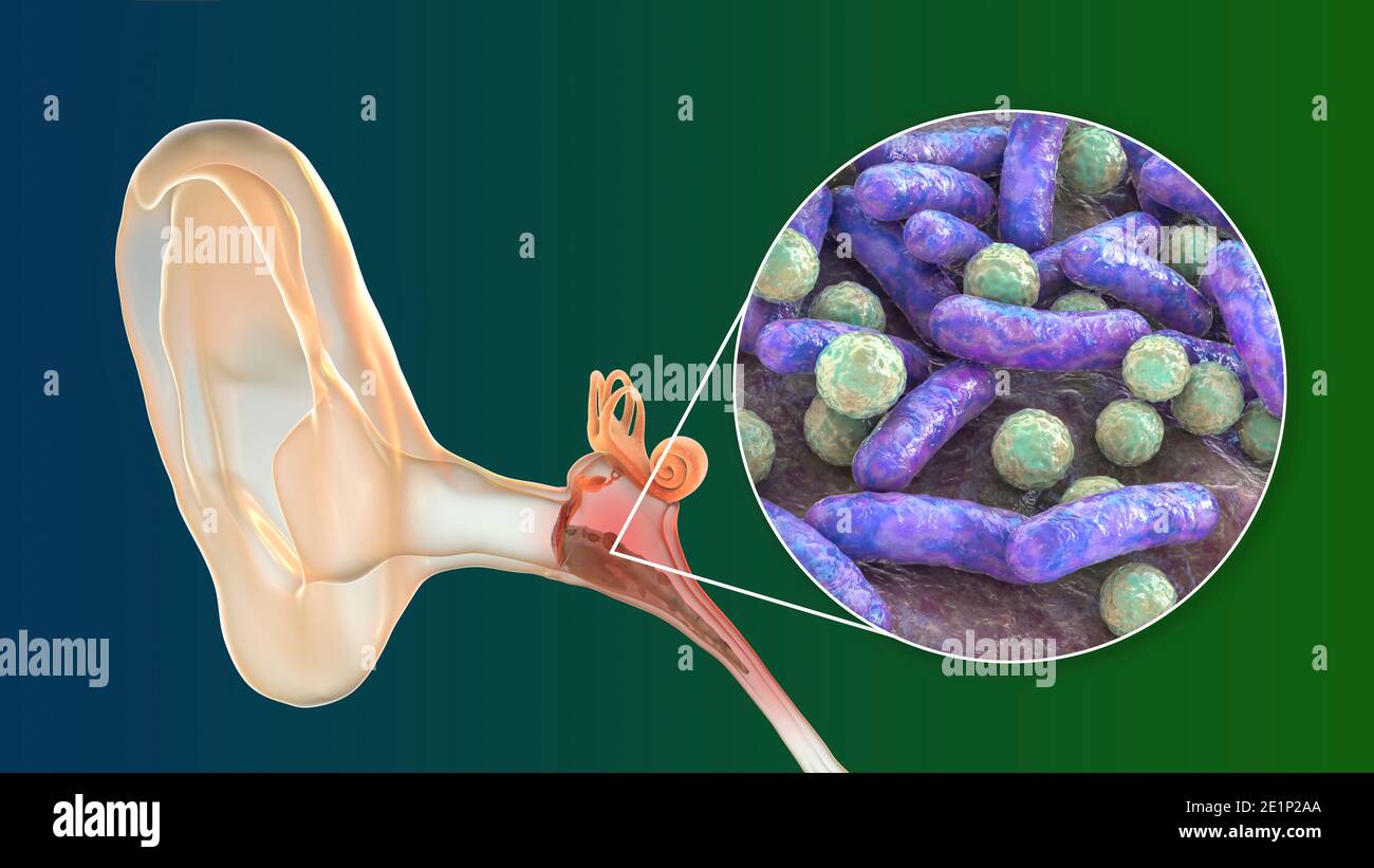 Infection de l'oreille du milieu de l'otite, illustration Banque D'Images