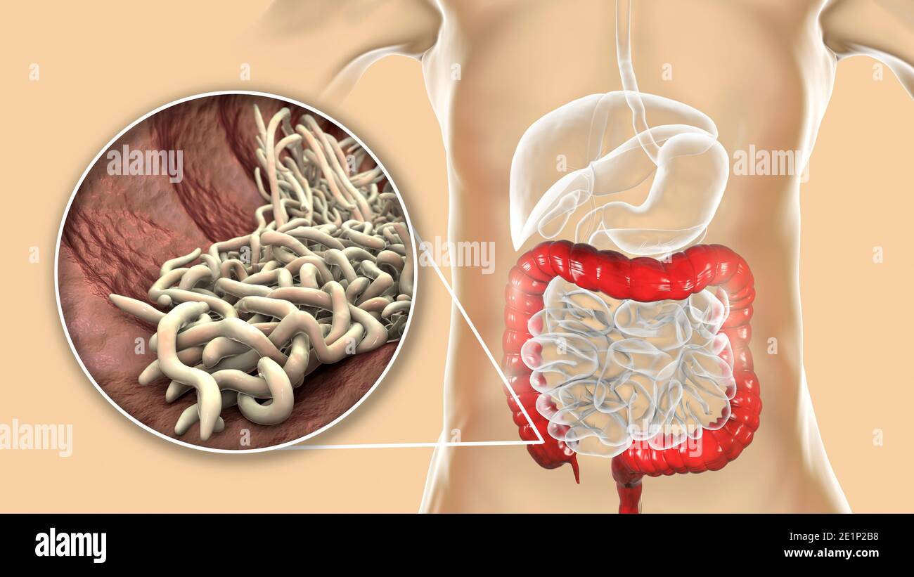 Vers ronds dans le gros intestin humain, illustration Banque D'Images
